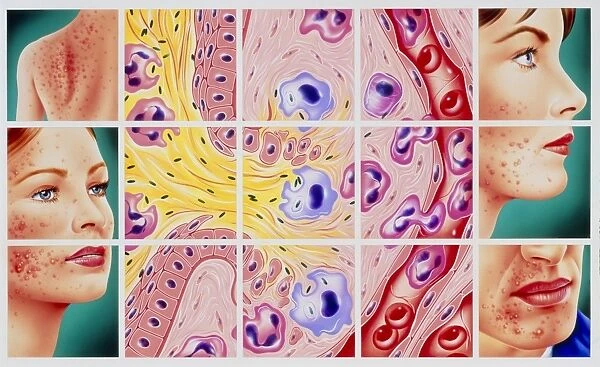 Artwork showing acne and rupture of follicle