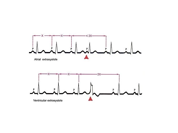 Extrasystole heartbeats, ECG artwork