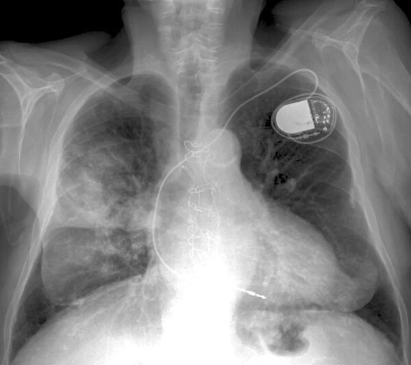 Heart and lung disease, X-ray C018  /  0498