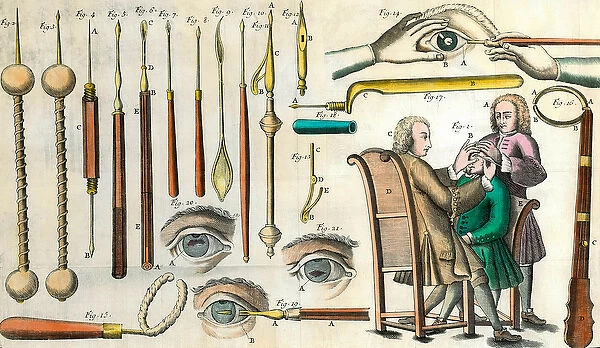 Surgery in the 18th century: eye operation. Instruments for cataract operation