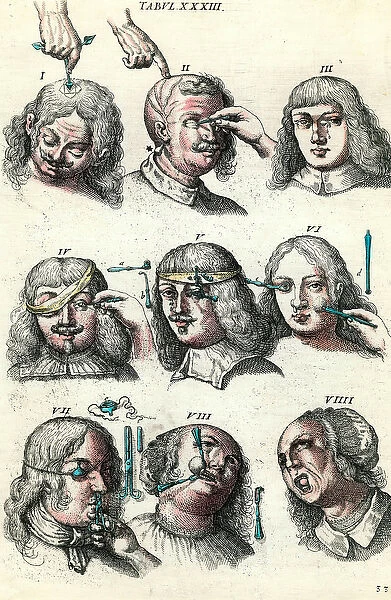 Surgery in the 18th century: Trepanation and operation of the eye and face