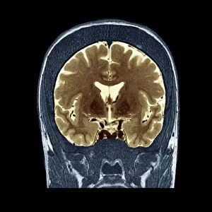 Thickened skull, MRI scan
