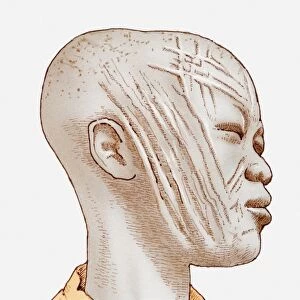 Illustration of African womans head showing scarring