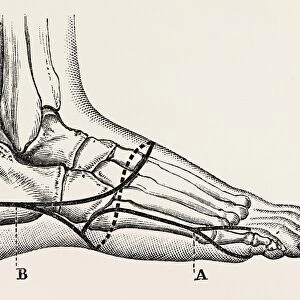disarticulation of the little toe, medical equipment, surgical instrument, history